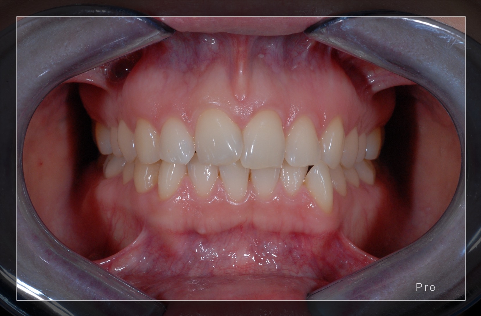 Apparecchio denti invisibile  Studio Dentistico Medical Service