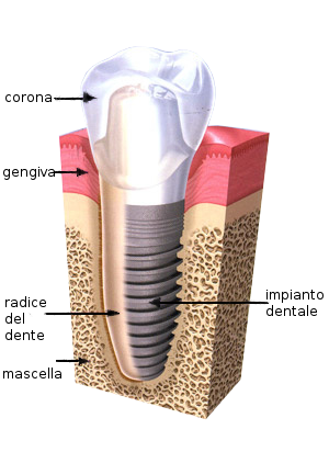 Impianto dentale